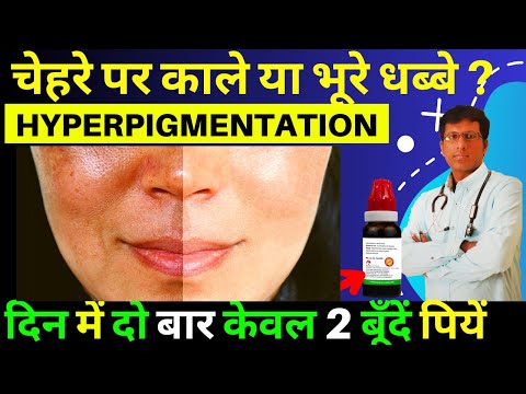 Homeopathic Remedies For Hyperpigmentation in Hindi