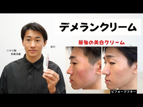 【美白】デメランクリームの効果と使い方！毛穴・ニキビ跡・ニキビ・シミ・クレーターに塗ってみた経過がヤバい。