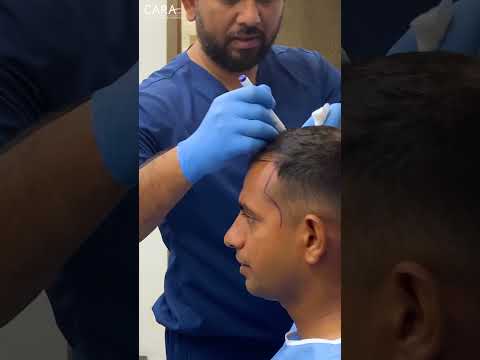 Get Your Hair Back with a LIFE CHANGING Hair Transplant!