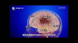 【科普教育】認識腦中風