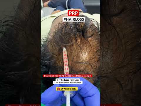 HAIR LOSS ,HAIR THINNING,MALE PATTERN BALDNESS—HAIR PRP TREATMENT #shorts