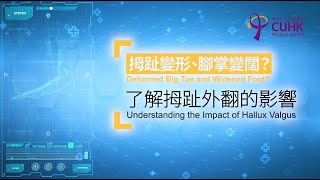 [醫生講場]拇趾變形、腳掌變闊？了解拇趾外翻的影響 Deformed Big Toe and Widened Foot?Understanding the Impact of Hallux Valgu