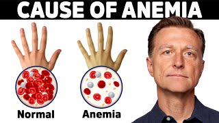 The Hidden Cause of Anemia You've Never Heard About