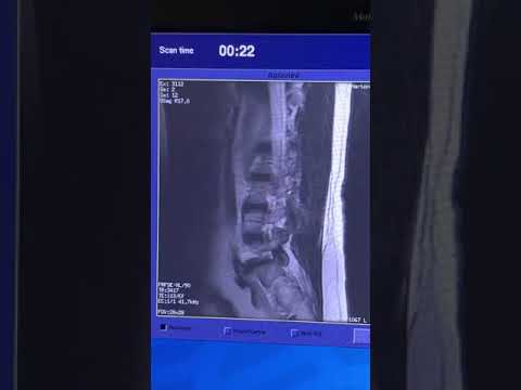 Spine MRI Artifact Caused by metal in MRI scanner- What does a Spine MRI look like?