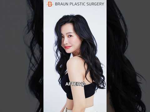 She is a BARBIE now!😍 #plasticsurgeryinkorea #beforeandafter #rhinoplasty #facialcontouringsurgery