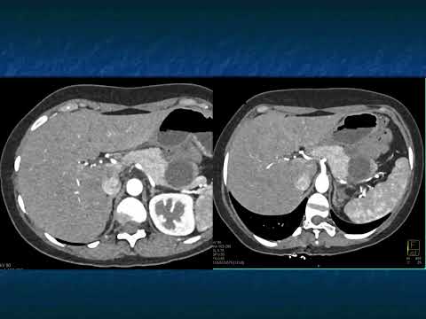 Cystic Pancreatic Lesions: Detection, Diagnosis and Management - Part 4