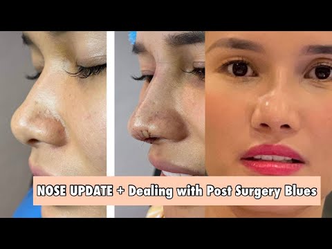 NOSE UPDATE (Dealing with Post Surgery Blues After Rhinoplasty) | Jen Barangan