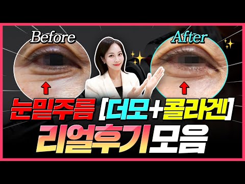 눈밑 주름 잡는 최고의 시술✨  [더모+콜라겐] 리얼후기 모음👩‍⚕️case별 시술방법💌 눈가주름 쫙 펴집니다