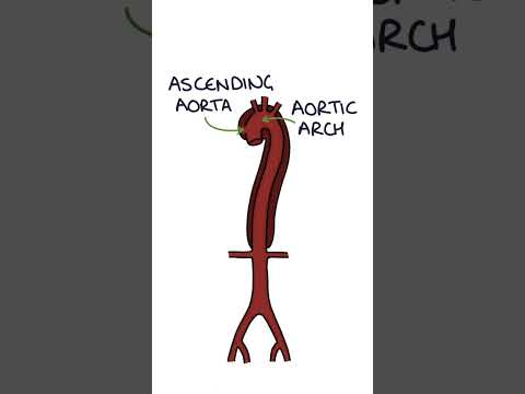 Aortic Dissection #medicine #vascularsurgery