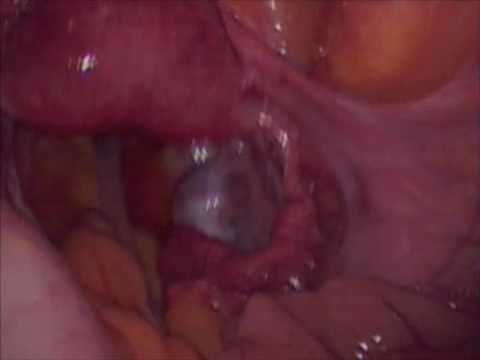 diagnostic laparoscopy.mp4