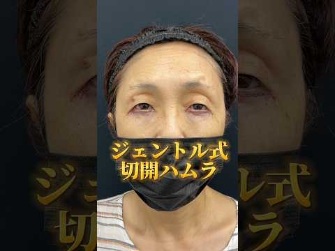 60代女性の目の下タルミ取り。脂肪注入なしで完璧に仕上げます☆ #眉下切開 #眼瞼下垂 #ハムラ法