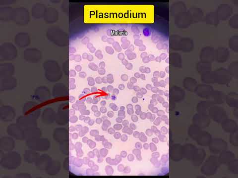 Malaria Under Microscope🔬