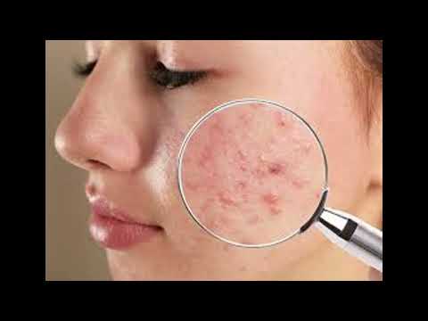 Beauty Tips Series Vol 2 - 5 What are the roles of AHA and BHA for acne prone skin?