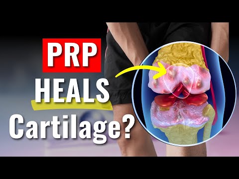 The Truth About PRP Injections & Cartilage Regeneration