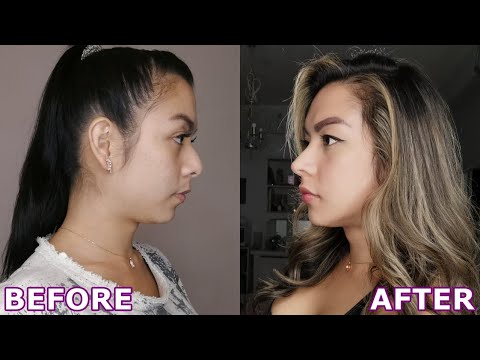 PLASTIC SURGERY IN KOREA : FACIAL FEMINIZATION SURGERY(FFS) PT.2