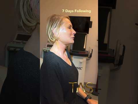 Scarless Deep Plane Facelift #plasticsurgerycenter #tasmedicalcenter #boardcertifiedplasticsurgeon