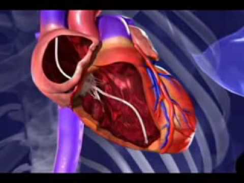 Animation: New therapy prevents heart failure