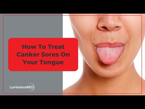 How to Treat Canker Sores on Your Tongue