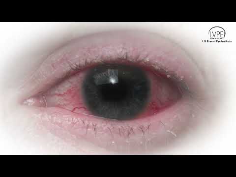 Types of treatment for Conjunctivitis