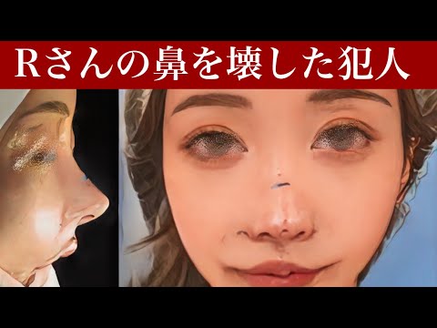 人気YouTuber、Rさんの鼻をピサの斜塔にした美容外科医まじ許せねぇ〜猫手術、貴族手術