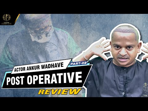 Best Hair Transplant with Honest Review by Ankur Wadhave | Post-Surgery Experience at Fusion Clinic