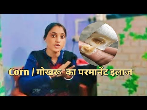 Corn / गोखरू का परमानेंट इलाज|corn treatment at home|Gharelu nuskhe @SaraBeautyCorner #corn#गोखरू