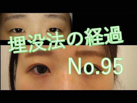 二重まぶた埋没法2点（ループ）止め　モニターさん1か月目の経過　95