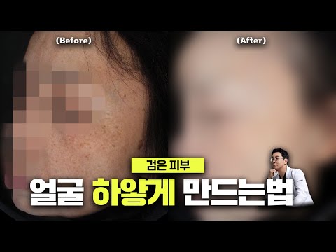 피부과 의사가 알려주는 피부 미백의 비결은 XXX입니다 / 검은피부 하얗게 만드는 방법