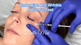 Crow's Feet & Under Eye (Jelly Roll) Anti Wrinkle (Botox) - Before, During & After