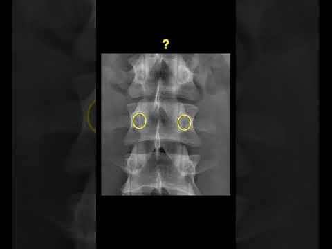 Testing Lumbar vertebrae using XRAYs #shorts