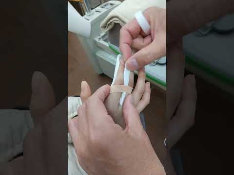 指関節固定　骨折疑い　finger fracture?