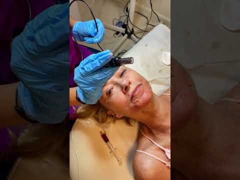 Vampire Facial Explained | Collagen Skin Treatment at Plantation Med Spa, Florida #shorts