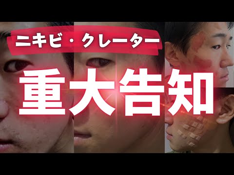 【重大告知】ニキビ・クレーター肌の治療についてご報告があります。