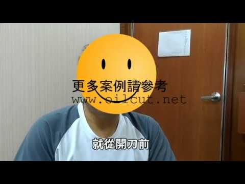 20171021 真實個案分享減重術後疼痛恢復經驗