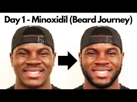 Day 1 - Minoxidil Beard Growth Journey