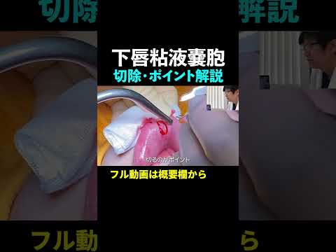 【唇のできもの】下唇粘液嚢胞の切除・ 摘出、ポイント超解説！（歯科口腔外科医ステップアップ①）#shorts