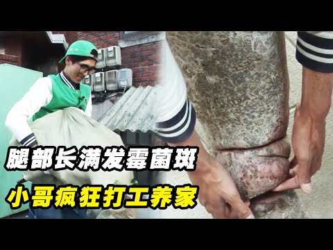 小哥腿部长满菌斑，拖着巨腿疯狂打工养家，家里老婆和两个孩子全靠他养活!纪录片