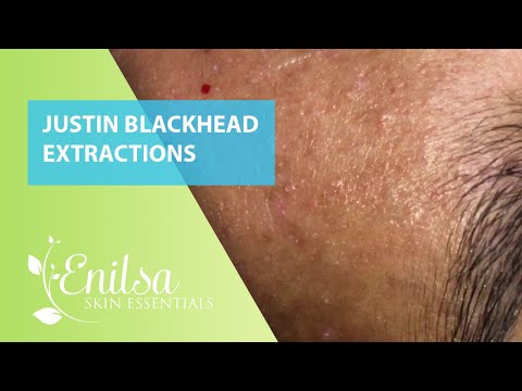 Blackheads Extractions Justin 2nd Treatment