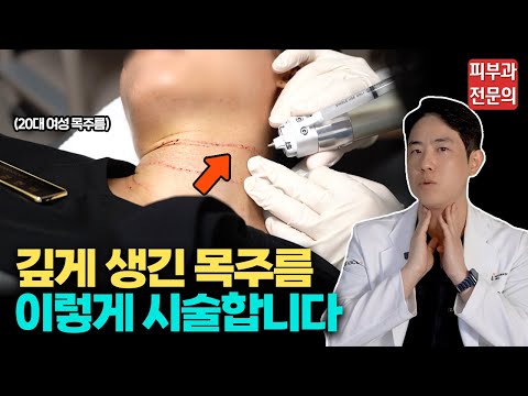 확 늙어보이는 목주름 피부과에선 이렇게 없앱니다 / 피부과 전문의 목주름 시술