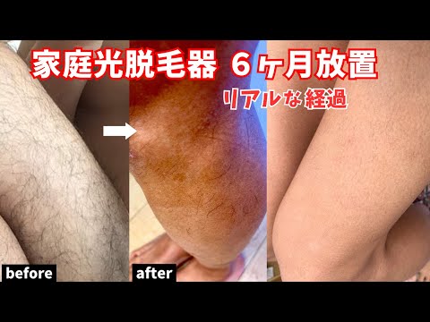 【ケノン】家庭用光脱毛器を使って６ヶ月放置したリアルな経過・・・