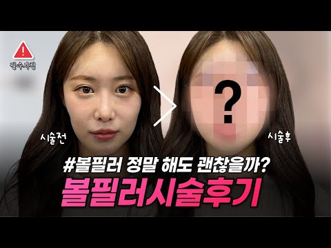 볼필러로 동안 만들기, 과연 진짜 가능할까? #볼필러 #시술후기