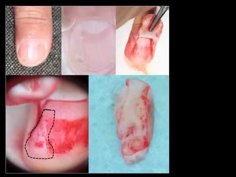 Pre-operation dermoscopy of the nail matrix by Dr. Luc Thomas