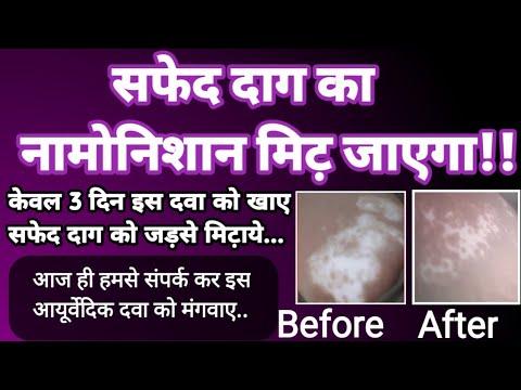 💥सफेद दाग की 100% रामबाण आयुर्वेदिक औषधी।।Vitiligo Treatment in hindi।।Leukoderma Treatment In Hindi