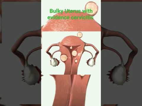 How to treatment Bulky Uterus with evidence cervicitis information infection What in bulky uterus wm