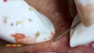 Blackheads Under Skin Extraction |poppy | 10st Treatment