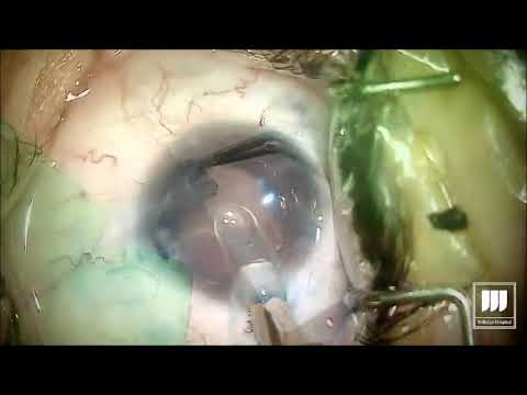 Iris prosthesis implant surgery