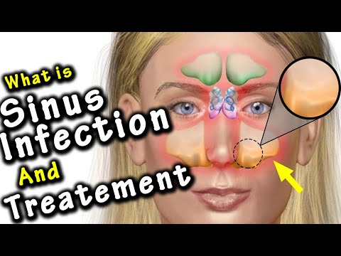 How to Get Rid of a Sinus Infection in 24 Hours | 5 Natural Remedies for Sinus Infection and Pain.