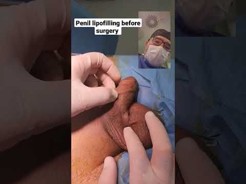 Penil lipofilling before surgery Dr Araz Bayramov #andrologist #penis #penileenlargementsurgery