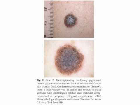 Melanoma incognito by Dr. Giuseppe Argenziano 1/2