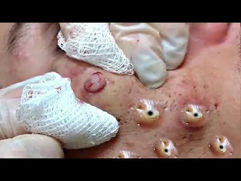 new blackheads this week